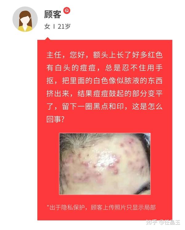 祛痘问答 || 挤痘痘后,留下了黑色痘印该怎么办?