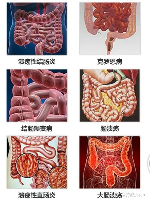 结直肠炎 zhuanlan.zhihu.com