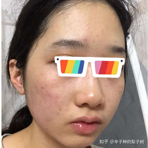 脸上长了很多又红又痒逆光疹子,有些透明的尖头看起来