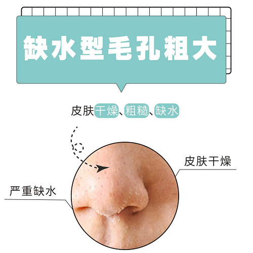 毛孔粗大怎么修复,了解毛孔粗大几种类型及修复方法