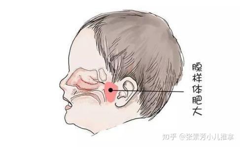 张素芳小儿推拿李波孩子腺样体肥大需要做手术切除可以试试小儿推拿