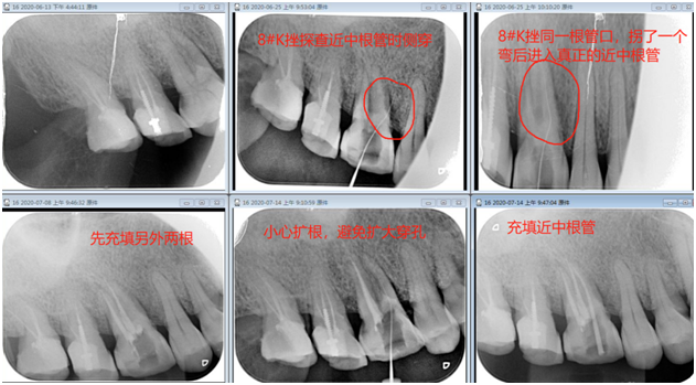 穿孔很大,牙齿外的软组织大面积暴露,大量鲜血渗出,炎症无法控制.