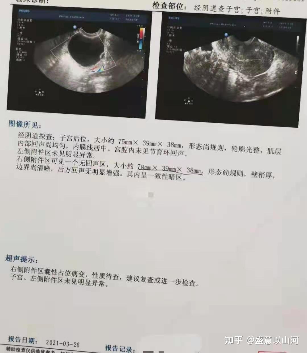 为什么二十几岁的女生会得卵巢囊肿