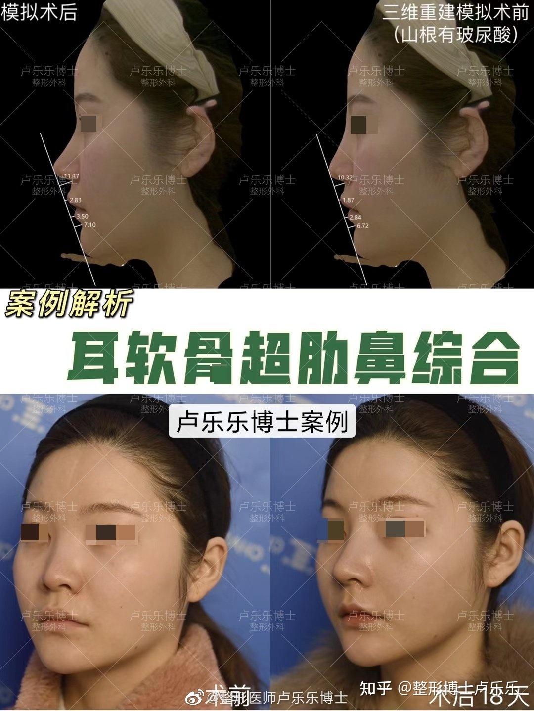 舒铂(超肋)做鼻子,安全吗?
