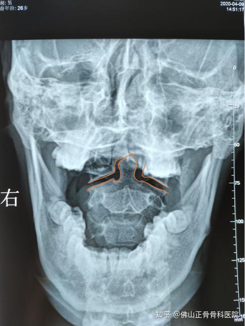 额头头痛一整天,原来是寰枢椎小关节紊乱!保守手法椎体复位改善头痛