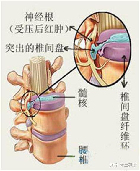 髓核游离