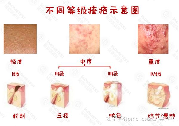 痤疮的发作,绝大部分是因为皮脂腺发炎引起,等级分为白头/黑头(两种都