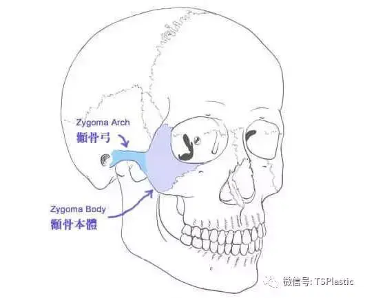 颧骨和颧弓的区别