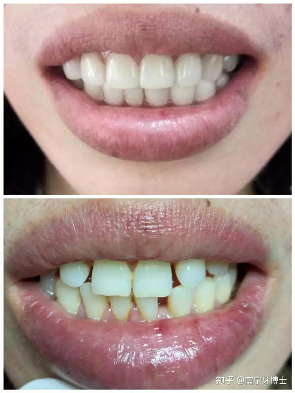 超薄瓷贴面丨拯救你的一口大牙缝
