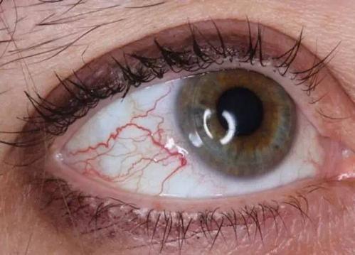 眼睛出现红血丝可能是2种病3个不良习惯用这4个办法解决