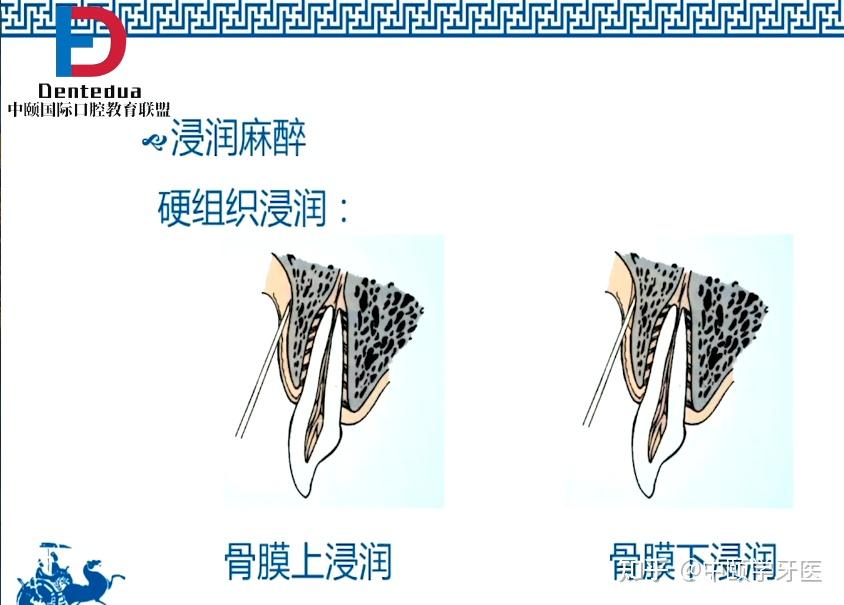 口腔局部麻醉中的浸润麻醉方法及失败对策北大口腔医院崔念晖