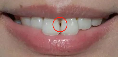 黑三角,却不知道它是什么原因造成的~ 当牙龈不能完全覆盖两个牙齿的