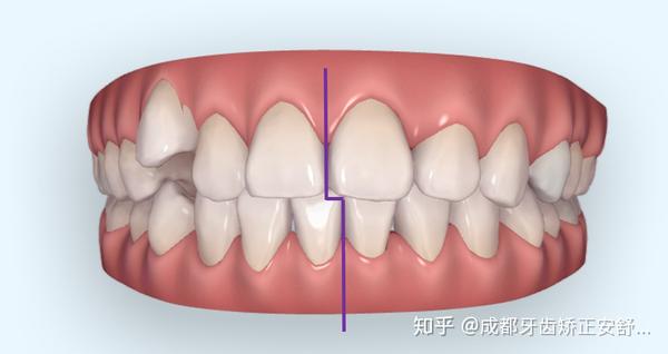 上颌第一恒磨牙的近中颊尖咬合与下颌第一恒磨牙的近中颊沟,所有的前