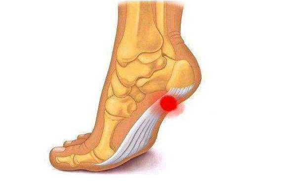 足跟痛主要原因包括脂肪垫损伤,跖腱膜紧张和跟骨下滑囊炎.