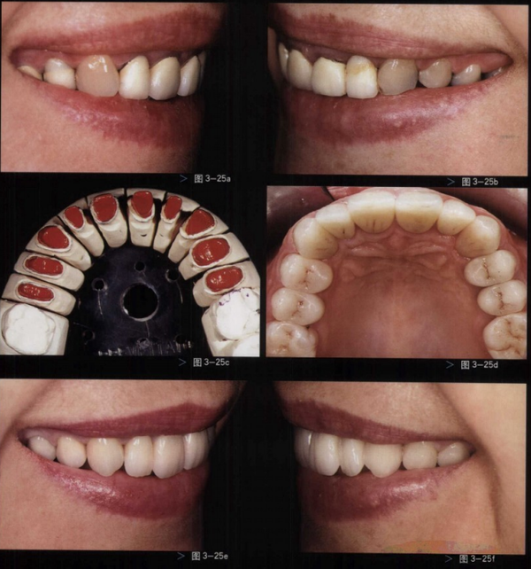 图3-25(a-f)对患者微笑宽度进行分析后,利用全瓷冠取代旧的修复体,从