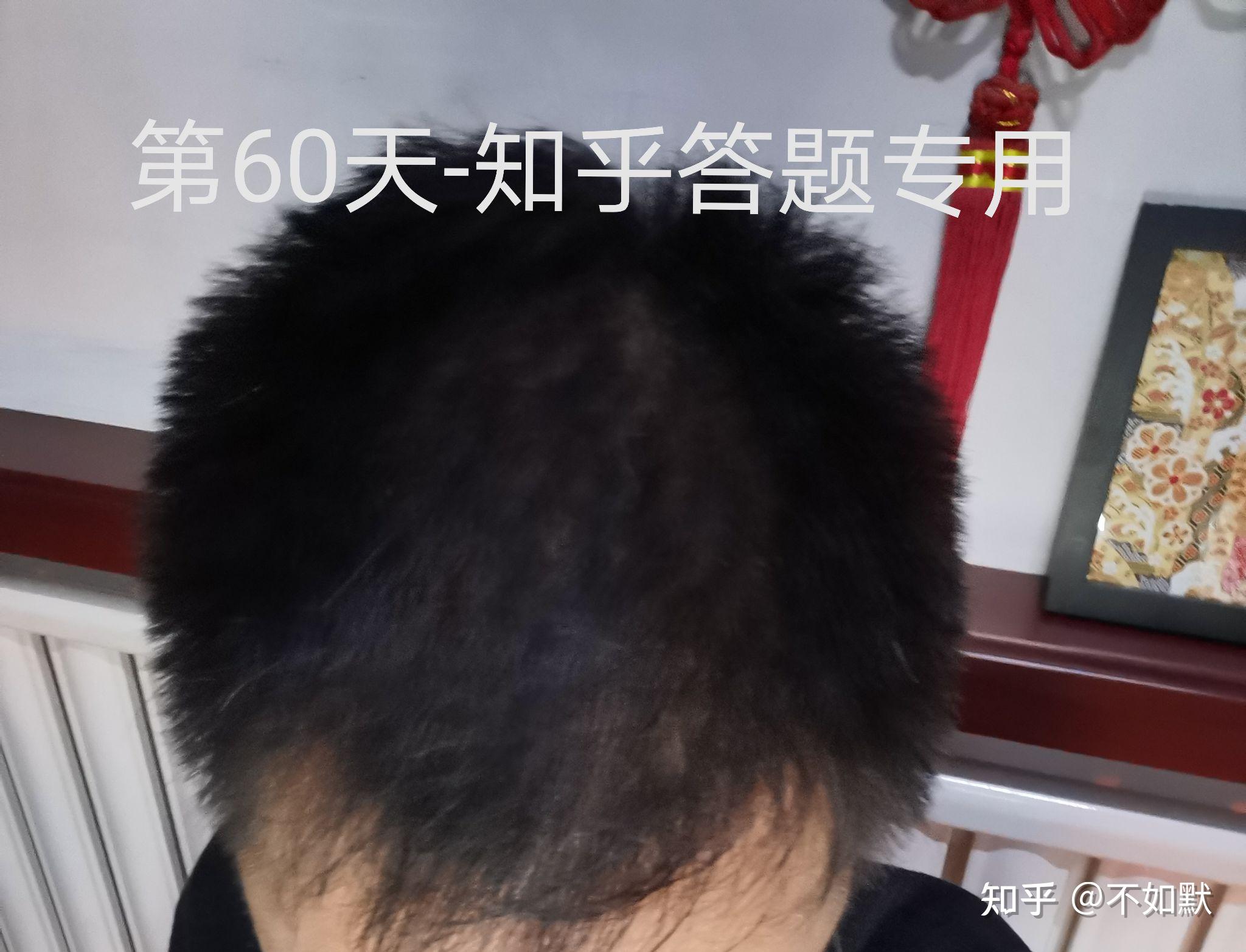 非那雄胺 米诺地尔使用三个月真实效果100天记录贴