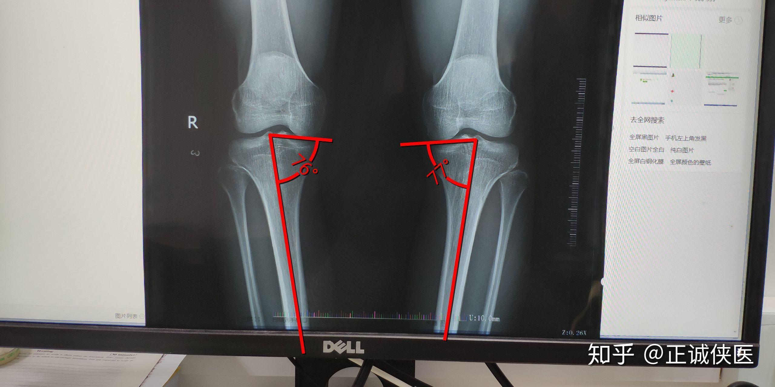 请问一下从x光片上看我的o型腿是关节畸形导致的还是肌肉力量问题啊