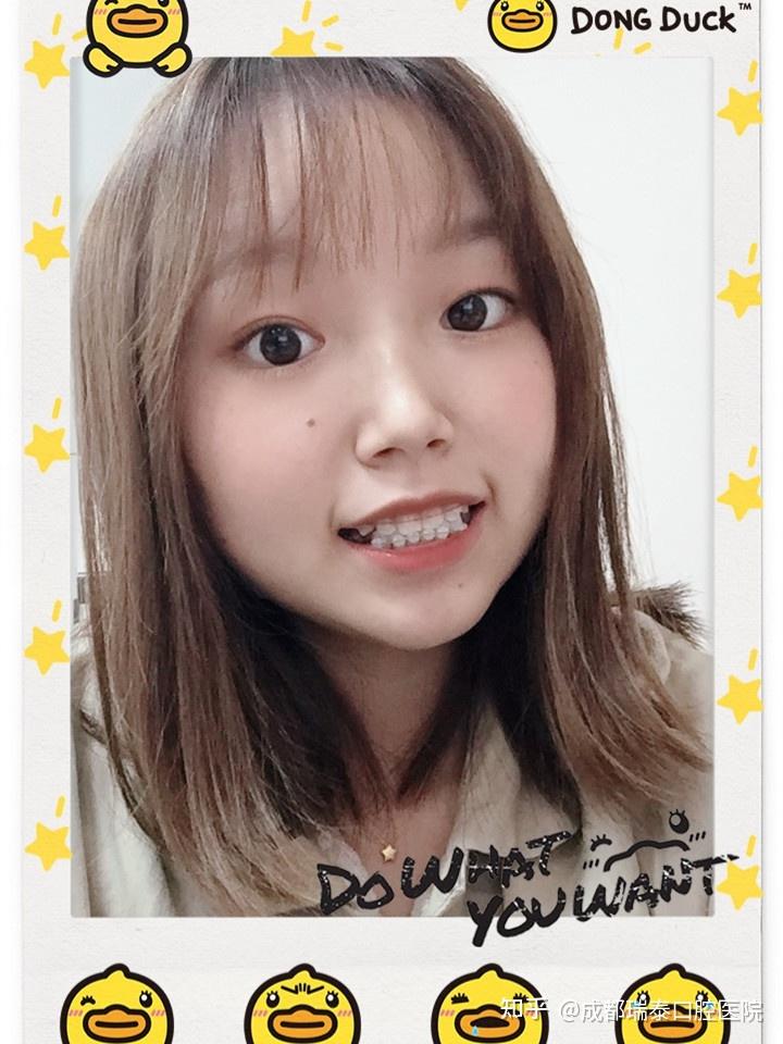 真实经历长相普通的女孩子矫正后改变大不大