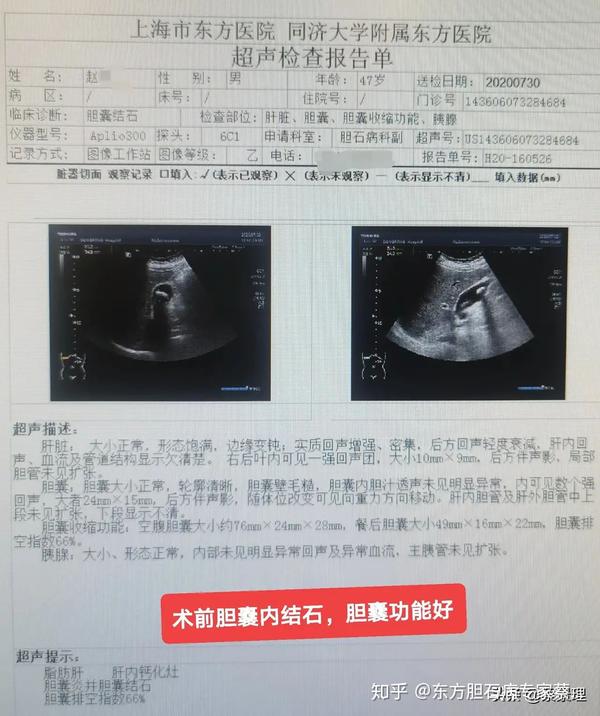 胆囊结石合并胆囊腺肌症,可以保胆吗?