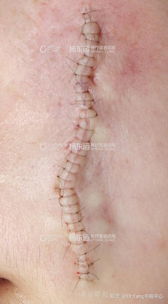 一例外伤后面部蜈蚣脚疤痕修复术
