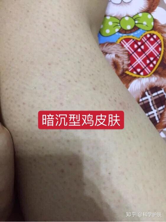 暗沉型鸡皮肤怎么去除,你是这样的鸡皮肤吗