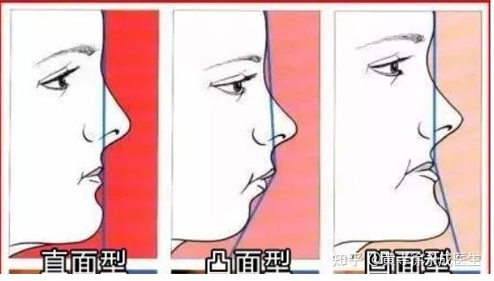 侧貌也由此可以简单分为直面型,凹面型以及凸面型几种.