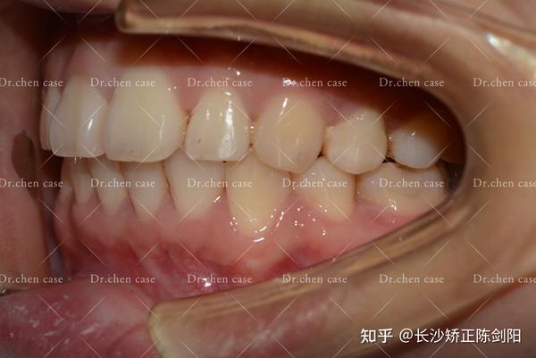 矫正后牙齿咬合正常,深覆盖消失,牙齿排列整齐.