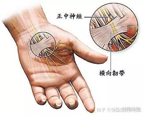 无效时可做 腱鞘切开手术, 术后应早期做屈伸手指活动,防止肌腱粘连