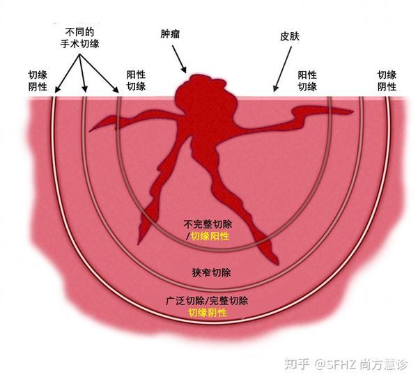 狭窄切缘.癌细胞靠近切除组织边缘,但不在切缘上.可能需要再次的手术.