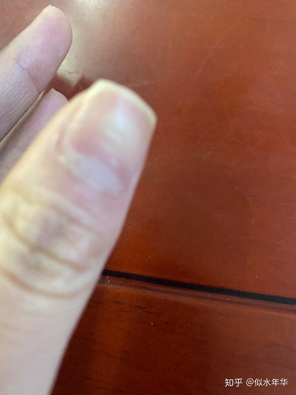 指甲不平稳大拇指是横向的纹理其余的是竖条纹脚趾甲也是