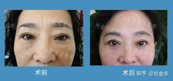 前后对比,可以看出眼袋,泪沟,眼角下垂等问题均很好改善,术后无痕迹
