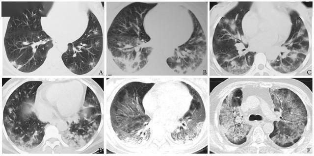 新型冠状病毒肺炎与间质性肺炎的鉴别诊断
