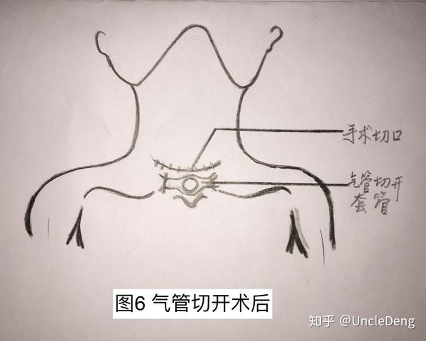 甲状腺癌侵犯气管1例