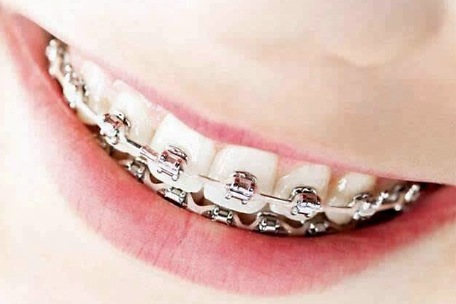 牙齿矫正有哪些危害在成都矫正牙齿需要注意什么问题成都牙齿矫正注意