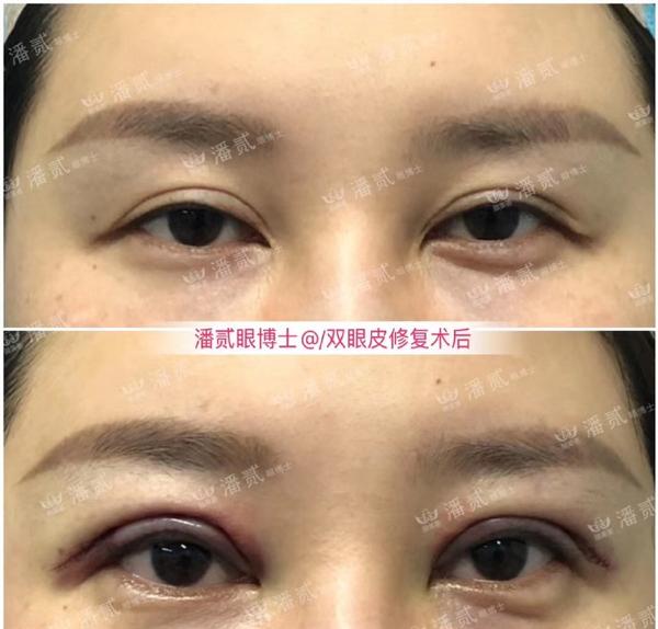 为什么双眼皮术后眼尾会鼓了个包是脂肪没有去除干净吗还是其它原因