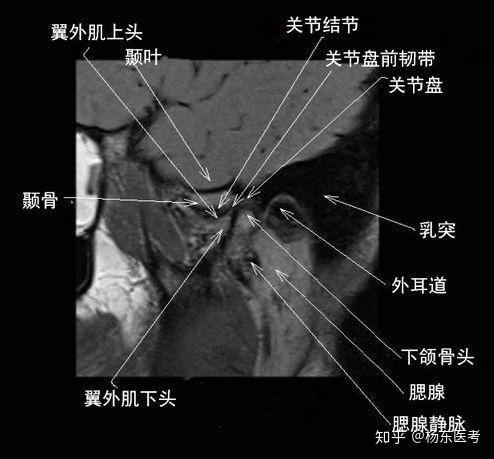 详细解剖示意图助你理解颞下颌关节