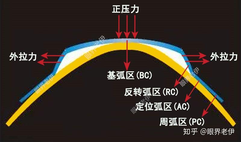 角膜塑形镜一文彻底详解