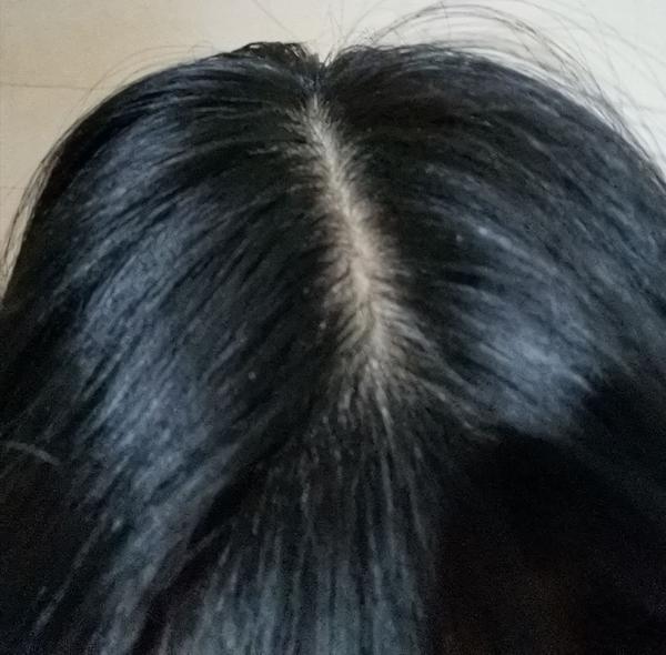 记录一下脂溢性脱发女生用米诺地尔的过程