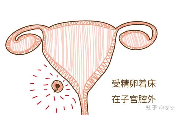 3,继发性腹腔妊娠 输卵管妊娠或破裂,胚囊从输卵管排到腹腔或阔韧带