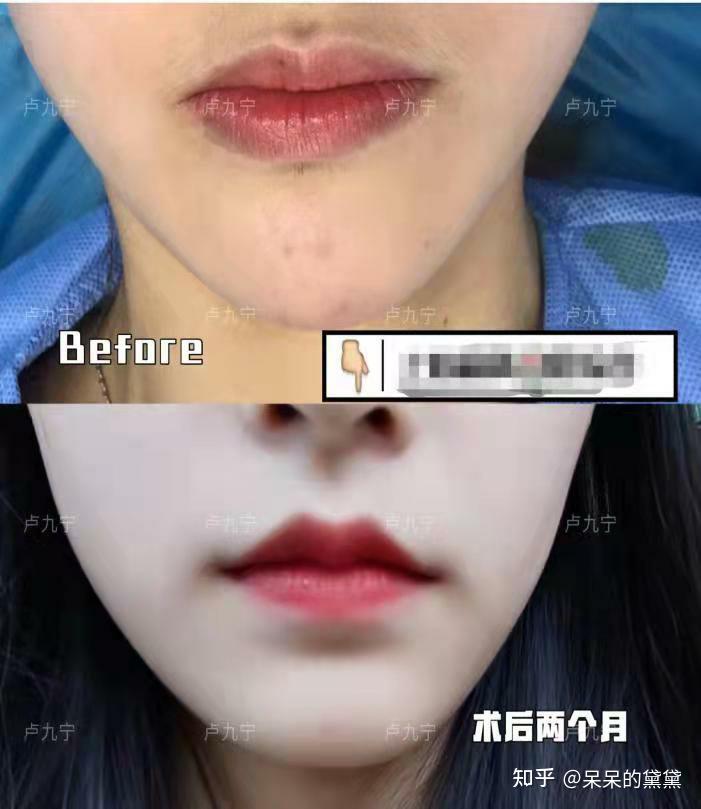厚嘴唇的烦恼tt有没有厚嘴唇的姐妹