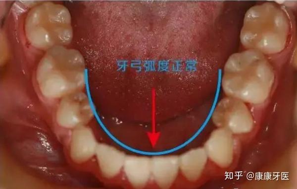 牙齿有一定的倾斜度,上前牙轻度前倾,上后牙轻度外倾,下前牙基本直立