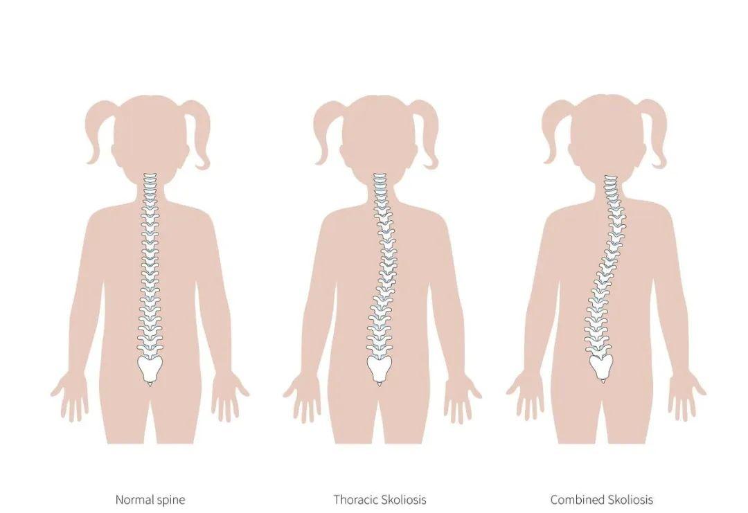 比驼背更吓人的竟是脊柱侧弯附自检与改善方法