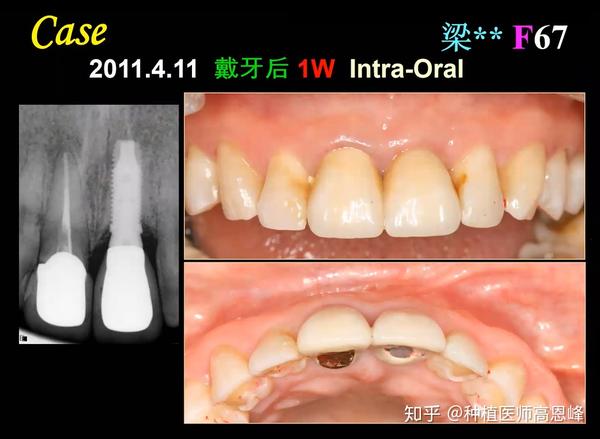 高恩峰医师案例:左边门牙根管治疗后佩戴牙冠,右边门牙为种植牙,完善