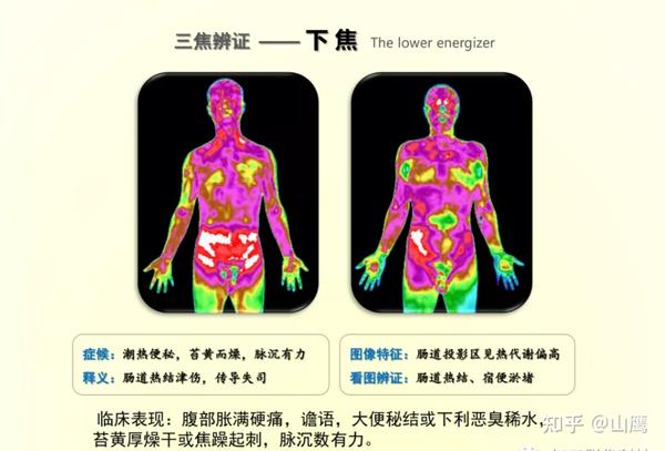 红外热成像在中医三焦辩证应用浅析