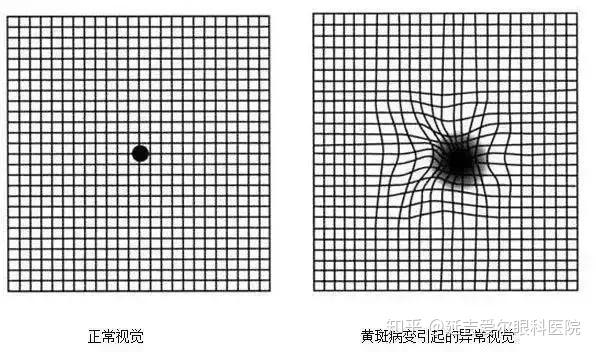 不是所有的视物模糊都是白内障