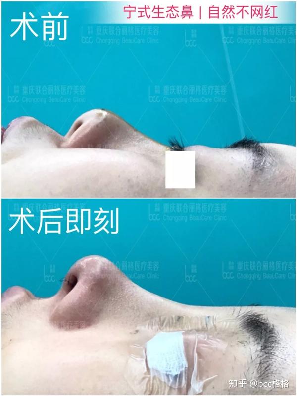 案例分享:中度鞍鼻矫正综合鼻手术