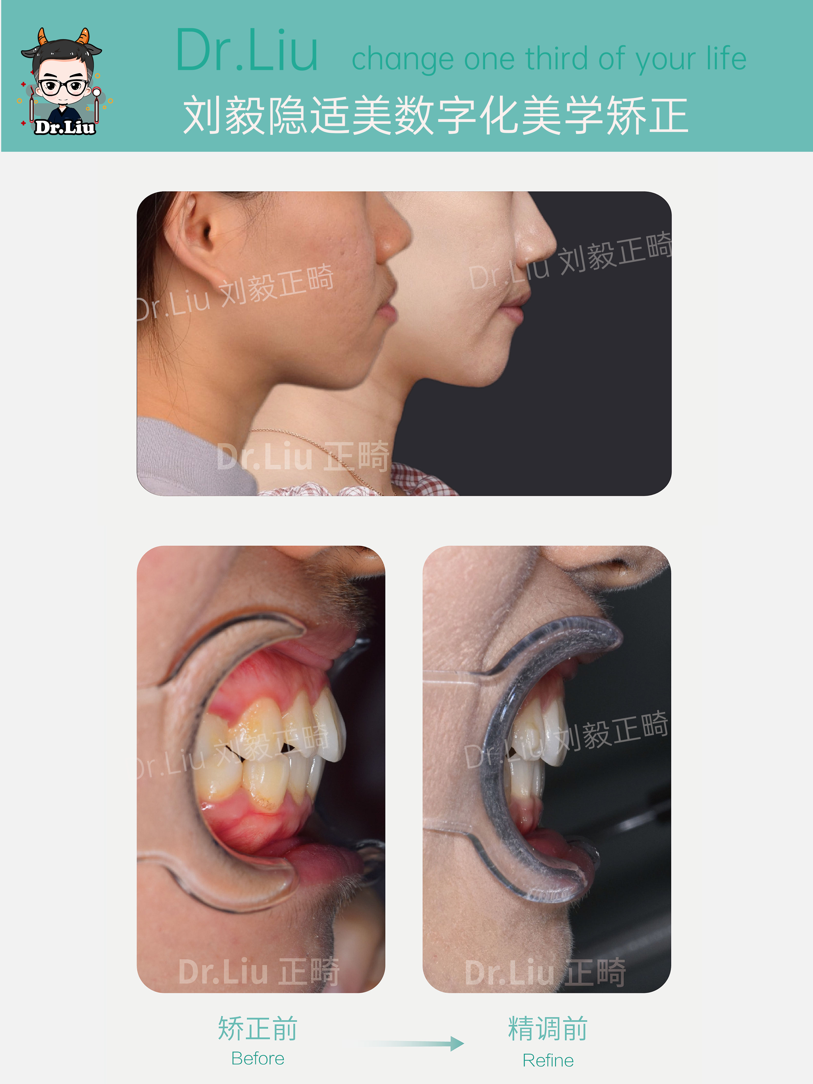 厦门牙齿矫正正畸戴牙套真的会带来变化吗