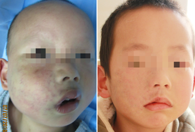 男婴出生半边脸青紫,血管瘤长大殃及唇部肿胀.