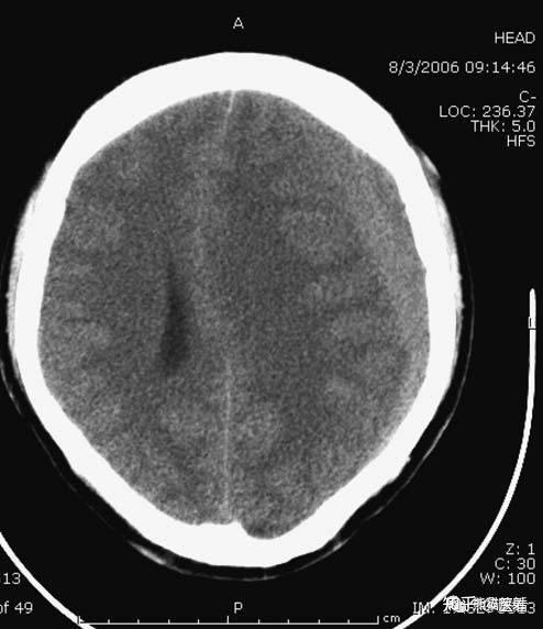 急诊颅脑ct不能漏的8种疾病