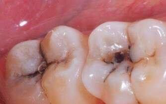 编辑 编辑 龋病是导致牙齿缺失的主要原因.
